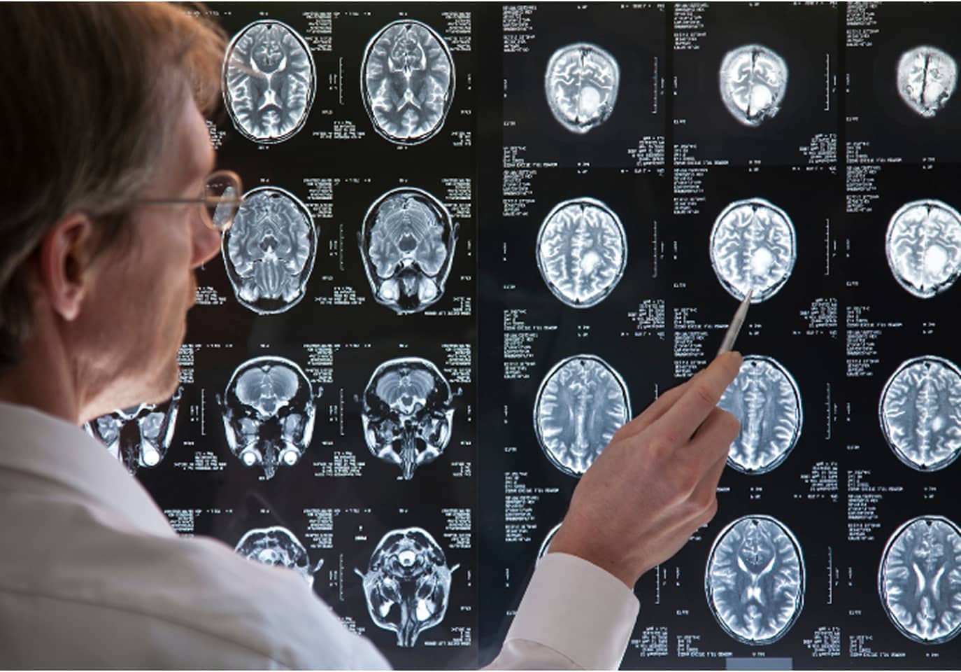 A doctor examines brain MRI scans on a lightbox, using a pen to point at specific images.