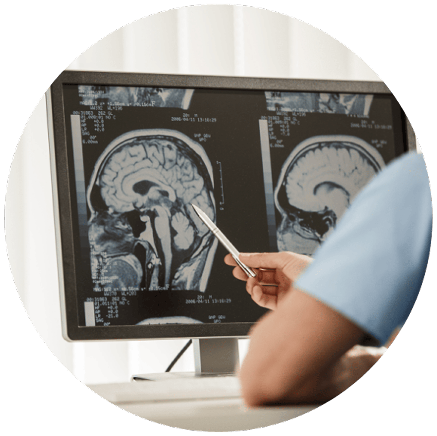 A person in medical attire points with a pen at a brain scan on a computer monitor.