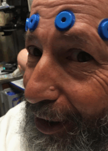 Patient undergoing a neurological test with sensors placed on the forehead.
