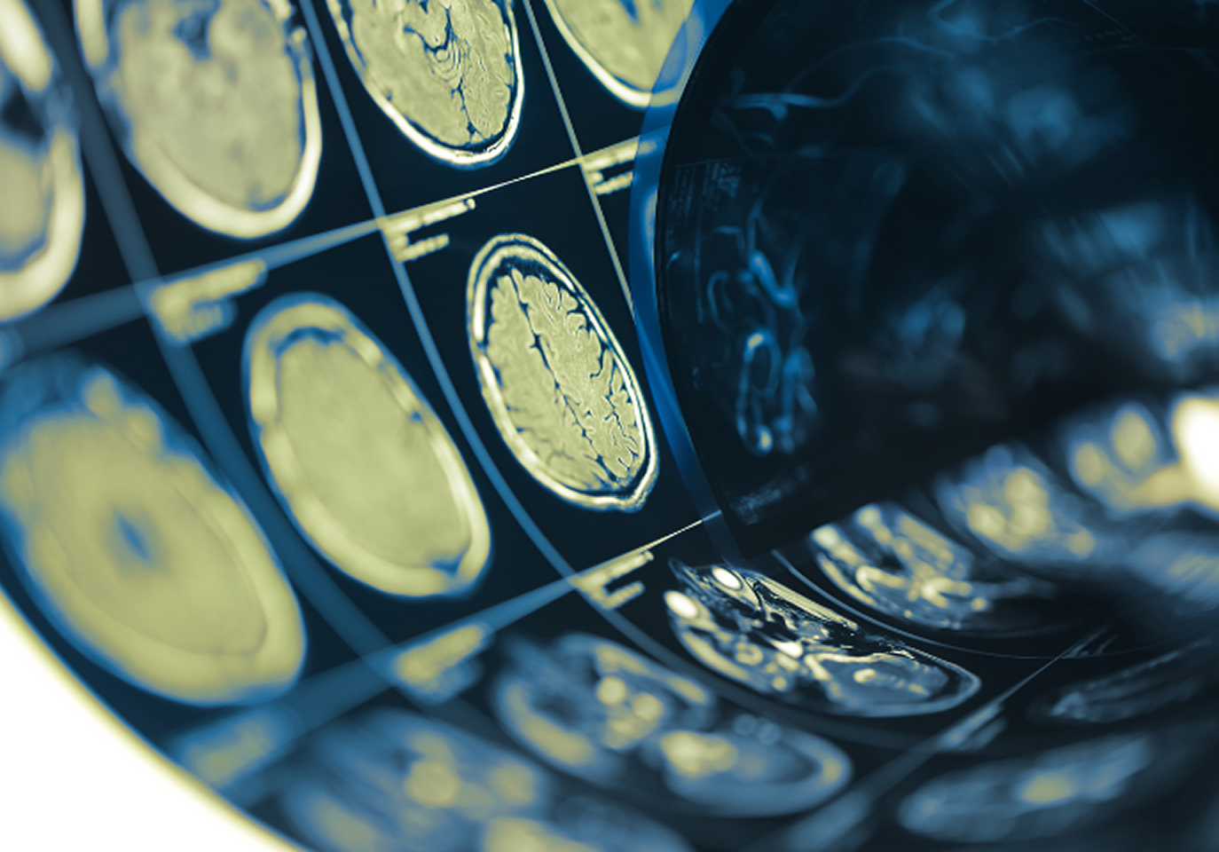 Blue-tinted MRI scans display brain cross-sections in a curved arrangement. The high contrast highlights detailed neurological structures.