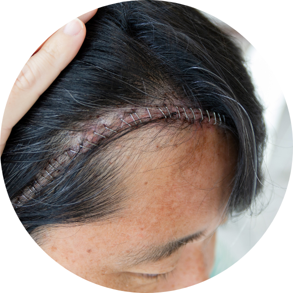 A close-up view of a person’s scalp showing a healing surgical incision with staples along the hairline, indicating recent brain surgery.
