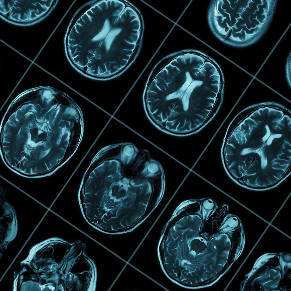 a close up of a brain MRI's results
